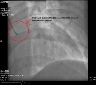 Angiogram, Angioplasty, Stent, Balloon….  Blog @ Bujang3